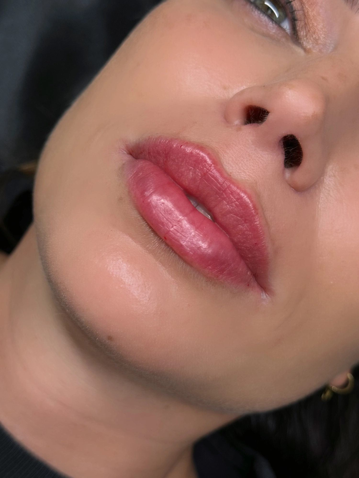 Russian Lips - Innova Clinics